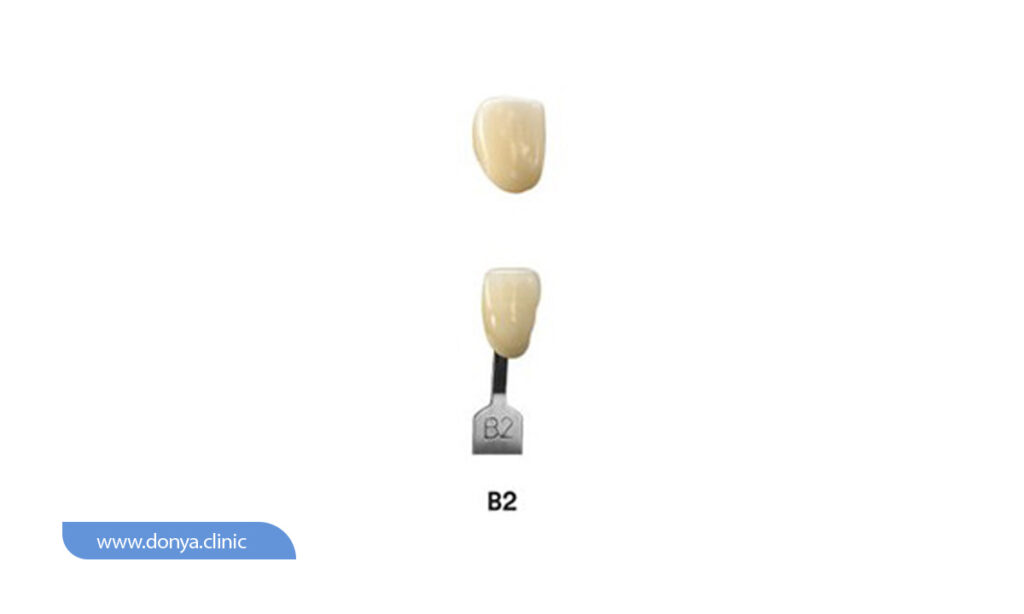 عکس رنگ لمینت دندان B2