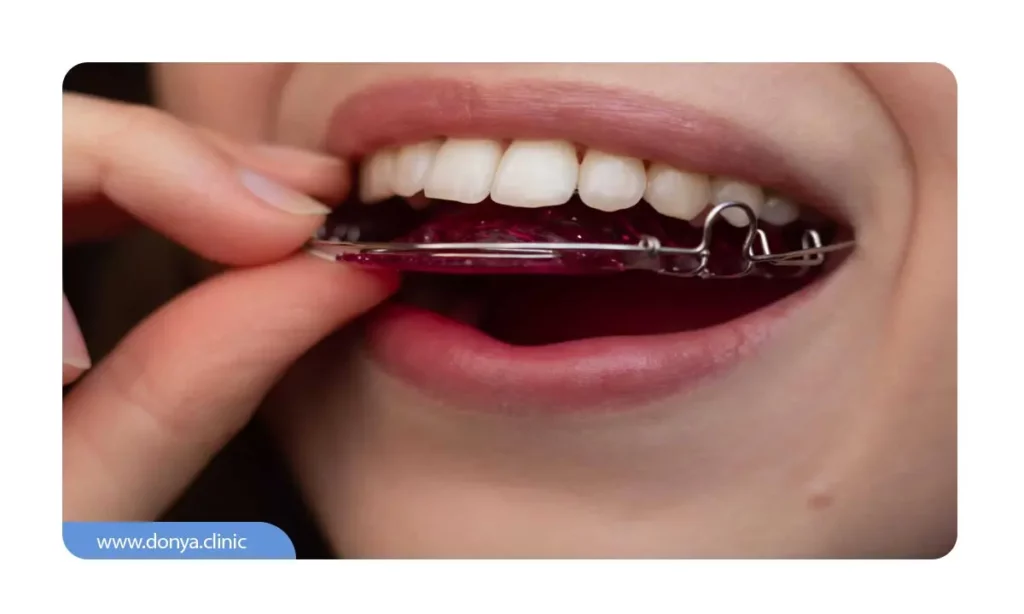 استفاده مداوم از ریتینر