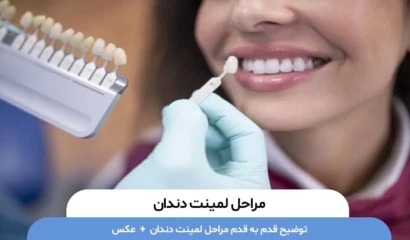 مراحل لمینت دندان