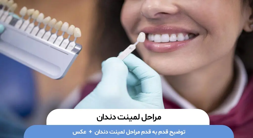مراحل لمینت دندان