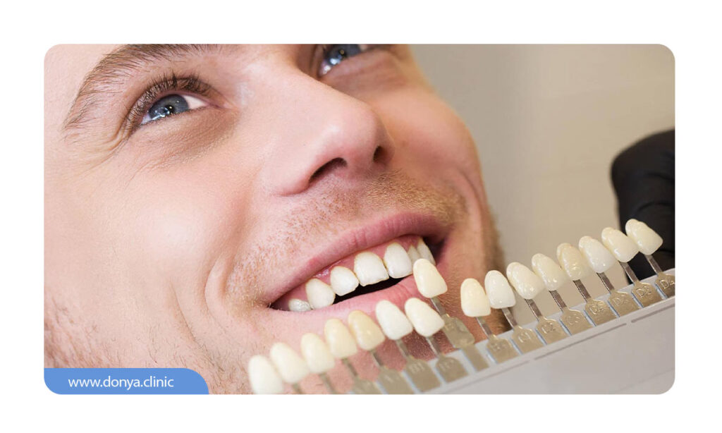 بررسی اندازه دندان ها برای انتخاب بهترین رنگ لمینت دندان