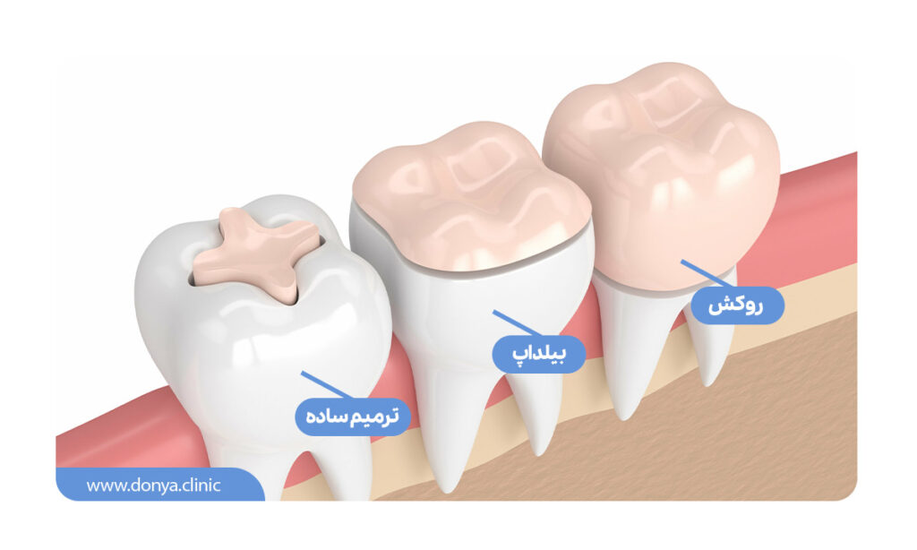 بلیداپ دندان ها