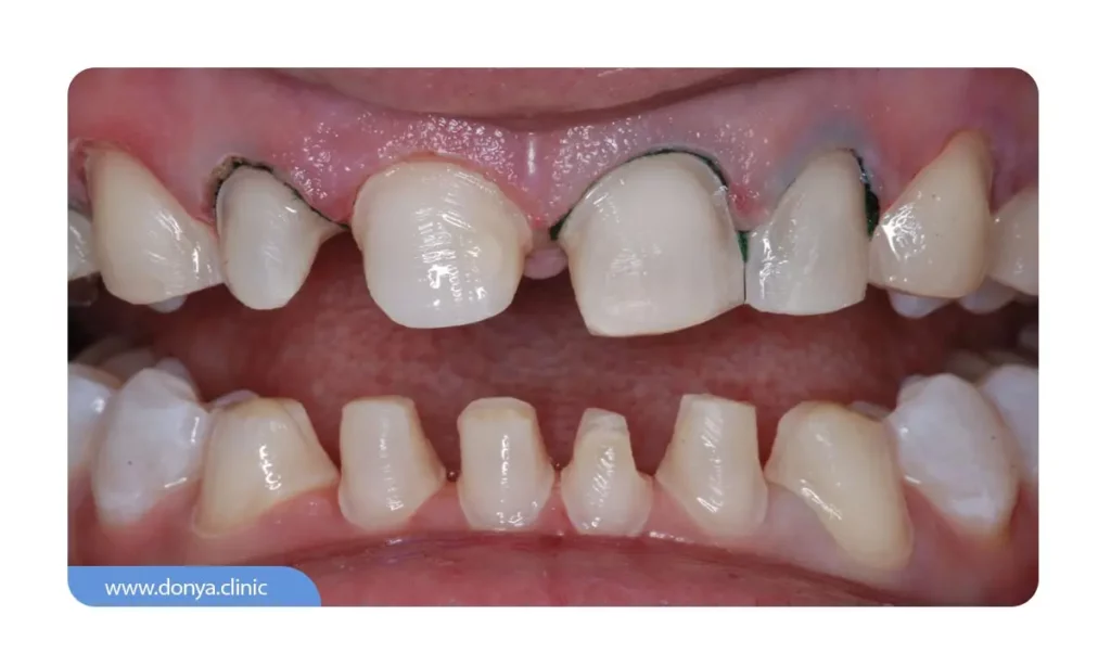 مرحله دوم :آماده سازی دندان ها 