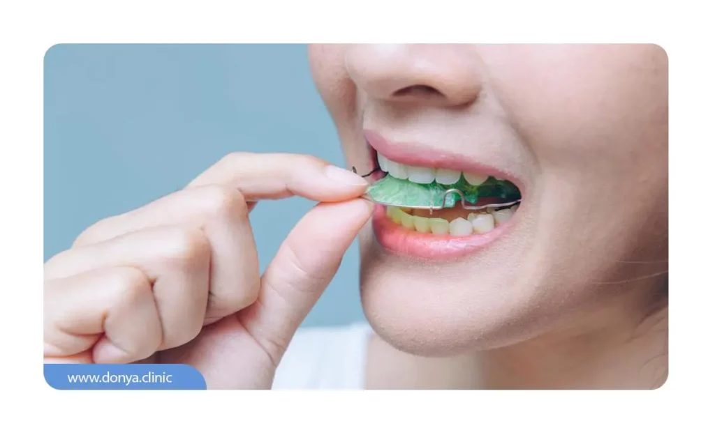  ریتینر یا نگهدارنده بعد از ارتودنسی