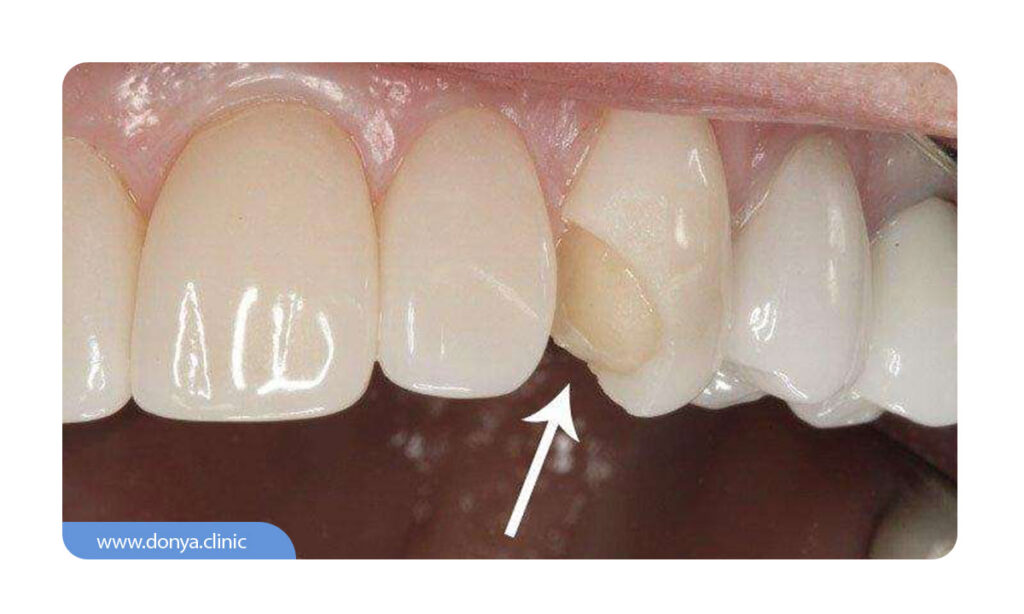 عکسی از آسیب دیدگی روکش لمینت سرامیکی دندان