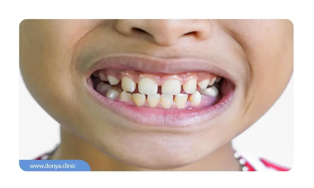 ایجاد فاصله بین دندان ها 