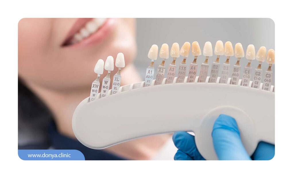 کدهای L، R و M در رنگ های لمینت دندان