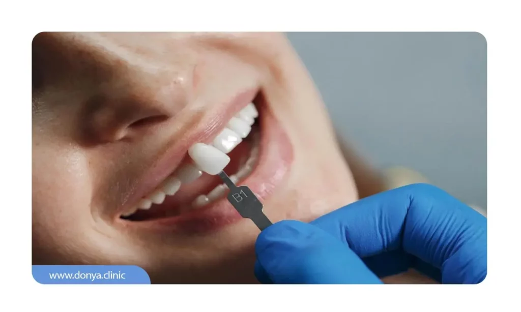 لمینت دندان چیست؟