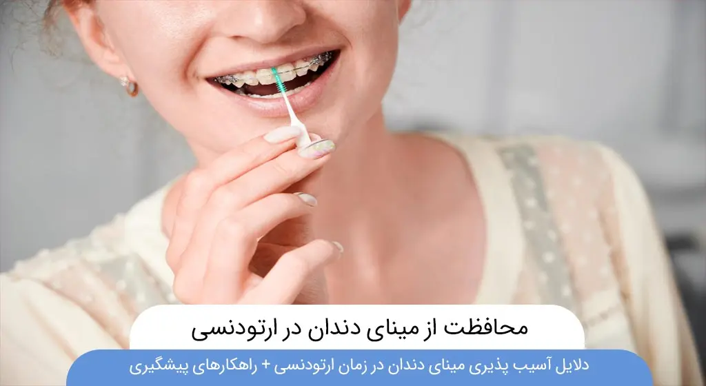 محافظت از مینای دندان در زمان ارتودنسی