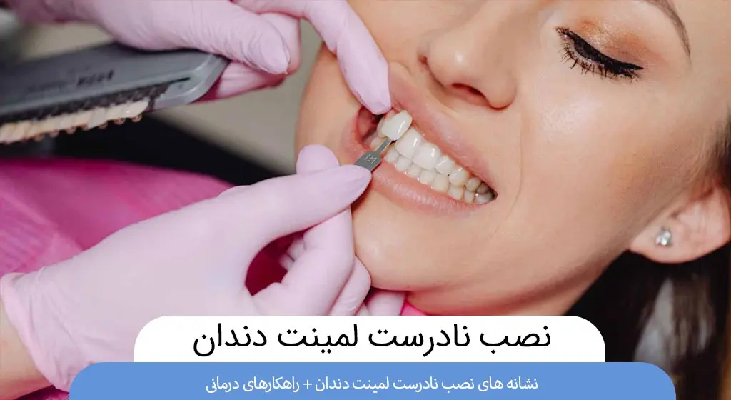 نصب نادرست لمینت دندان