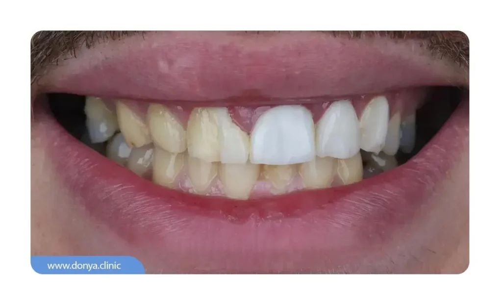 نشانه های نصب نادرست لمینت دندان