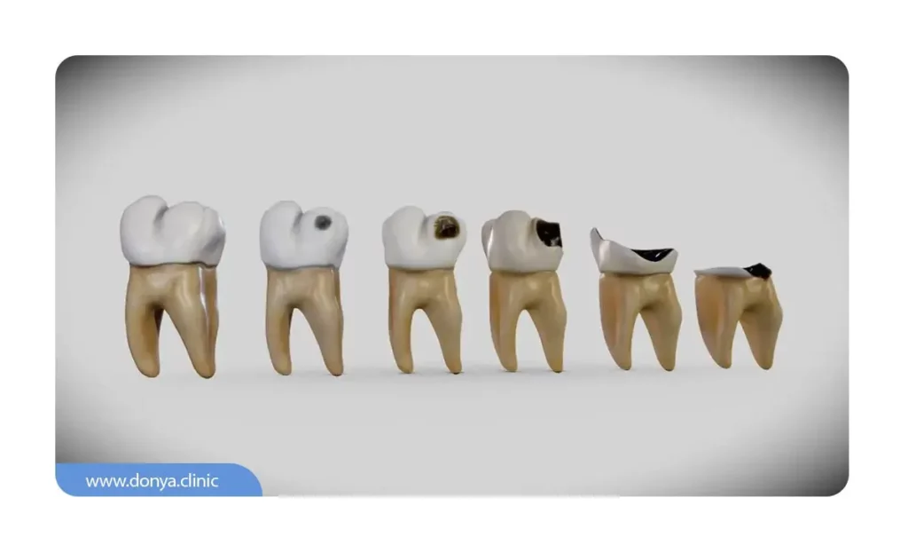 مراحل نشان دادن پوسیدگی دندان 