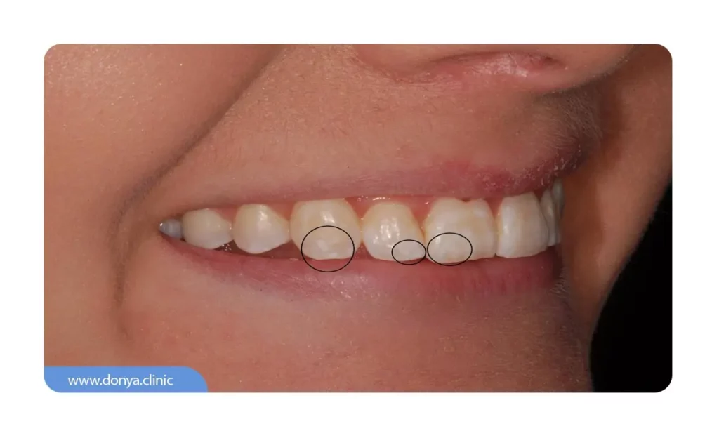 نشانه های اولیه آسیب مینای دندان در ارتودنسی