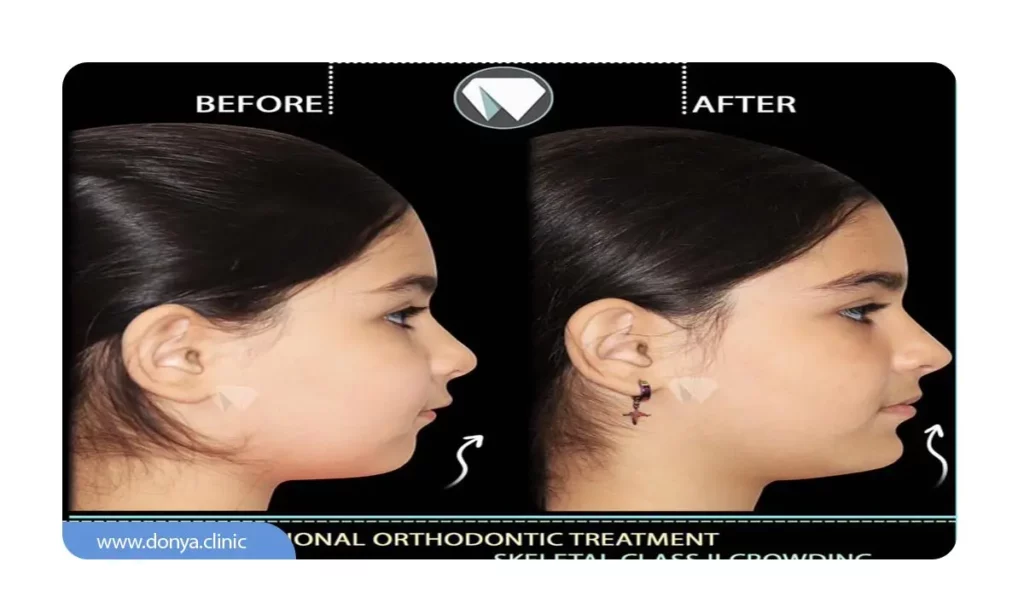 تاثیر ارتودنسی بر لب ها 