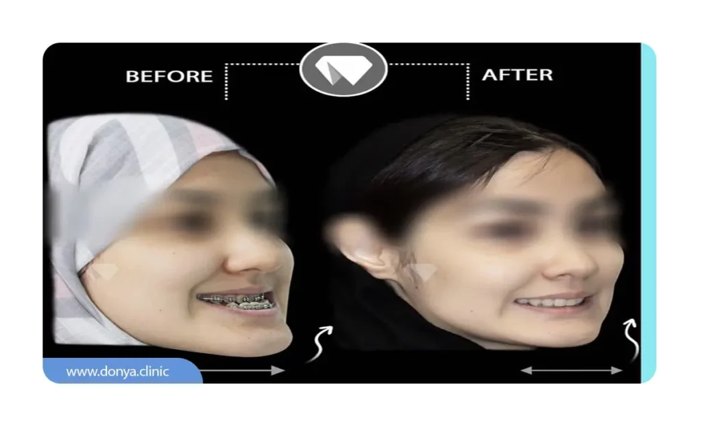 تاثیر ارتودنسی بر نیمرخ