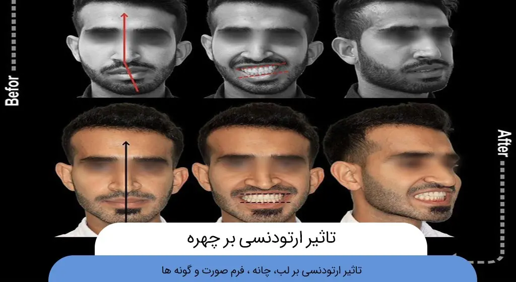 تاثیر ارتودنسی بر چهره