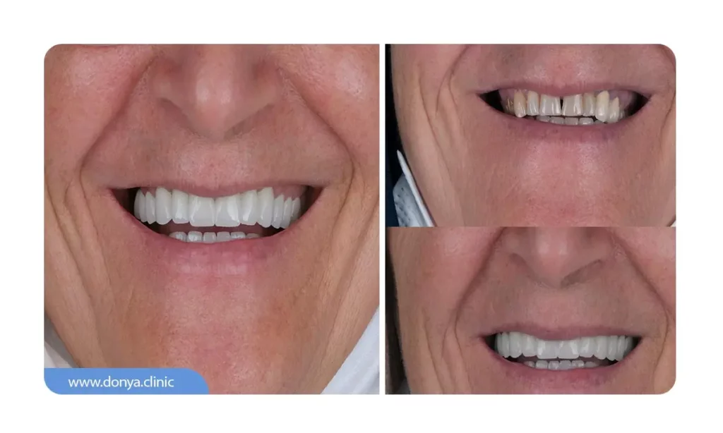 لمینت چگونه باعث زیبایی لبخند می شود