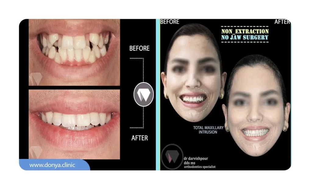 ارتودنسی چگون باعث زیبایی لبخند می شود