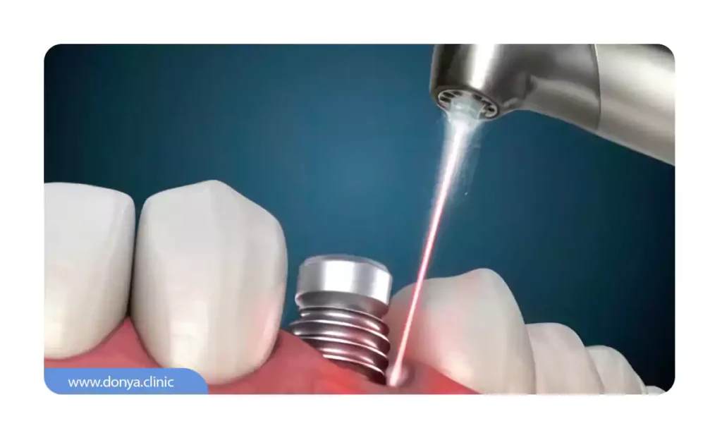 ایمپلنت دندان با لیزر