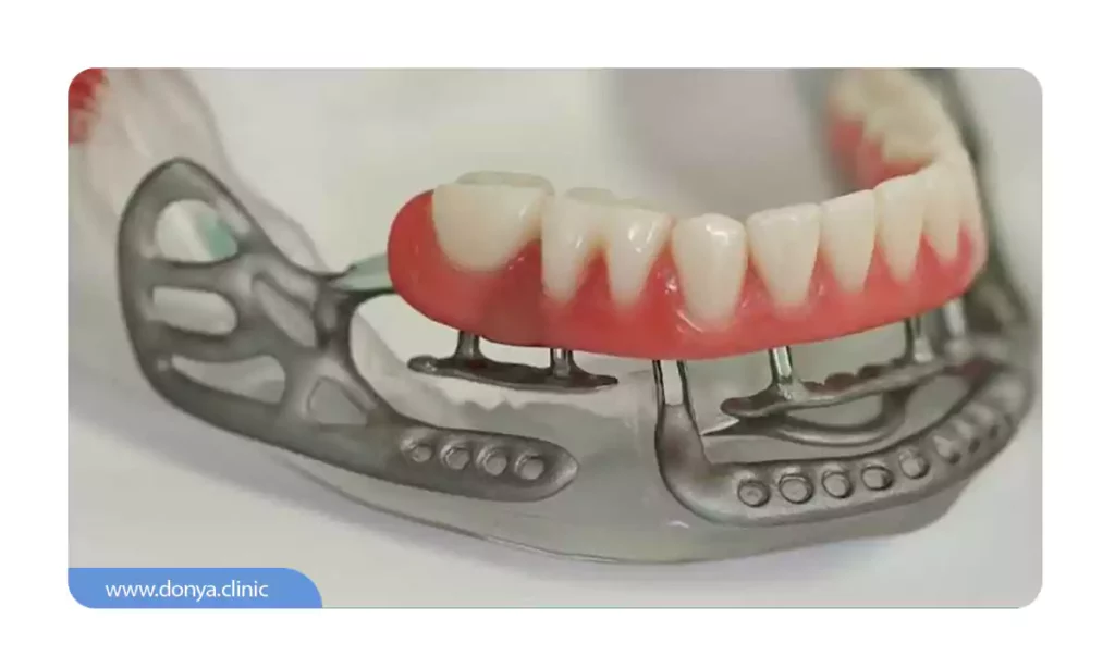 ایمپلنت ساب‌پریواستیل