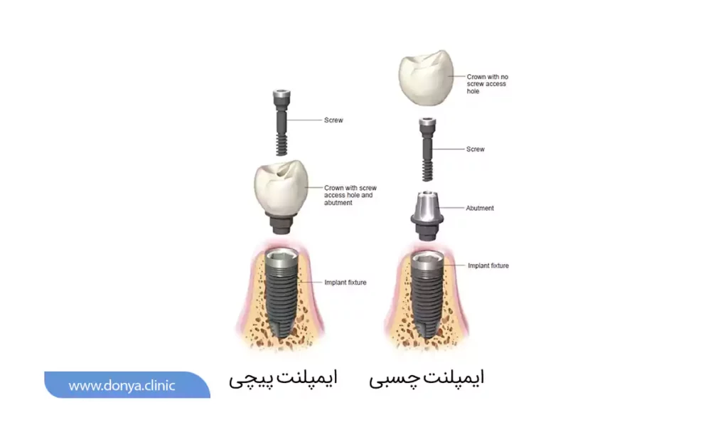 ایمپلنت چینی یا چسبی؟