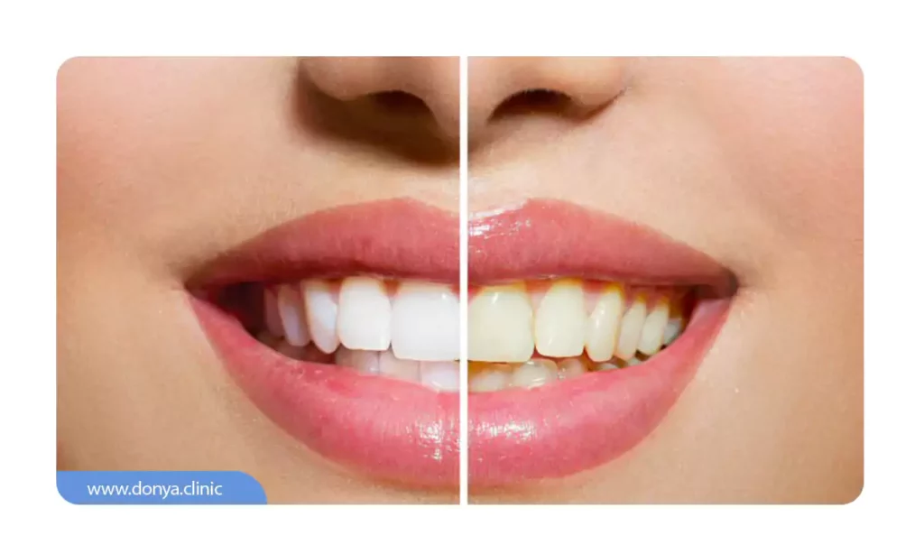 عکس از تغییر رنگ کامپوزیت دندان