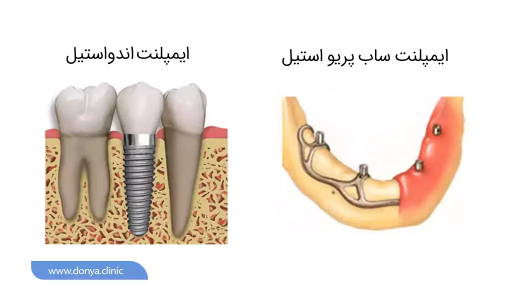 عکسی از ایمپلنت اندواستیل با ایمپلنت ساب پیرو استیل در یک نگاه