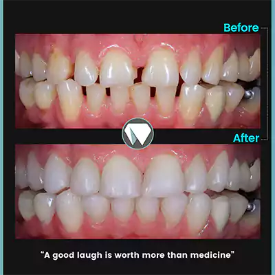 قبل و بعد نمونه کار درمان نصب کامپوزیت دندان کلینیک دندانپزشکی دنیا