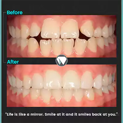 قبل و بعد نمونه کار  نصب کامپوزیت ونیر کلینیک دندانپزشکی دنیا
