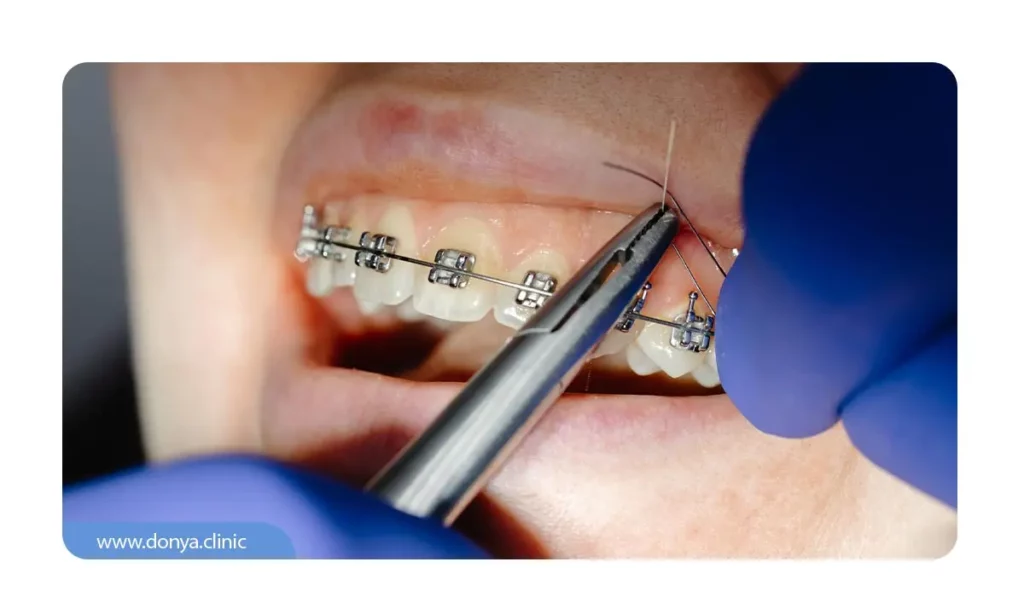 بیرون زدگی سیم ارتودنسی