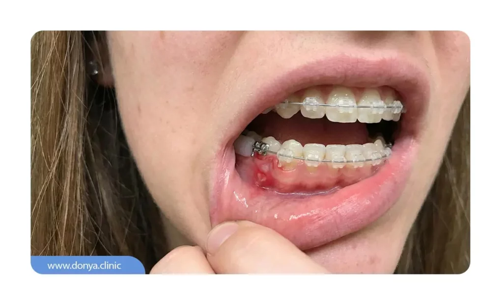 زخم های داخل دهان ناشی از بریس