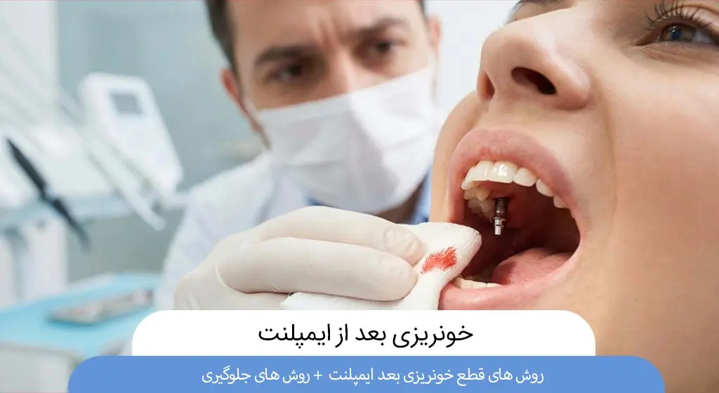خونریزی بعد از ایمپلنت
