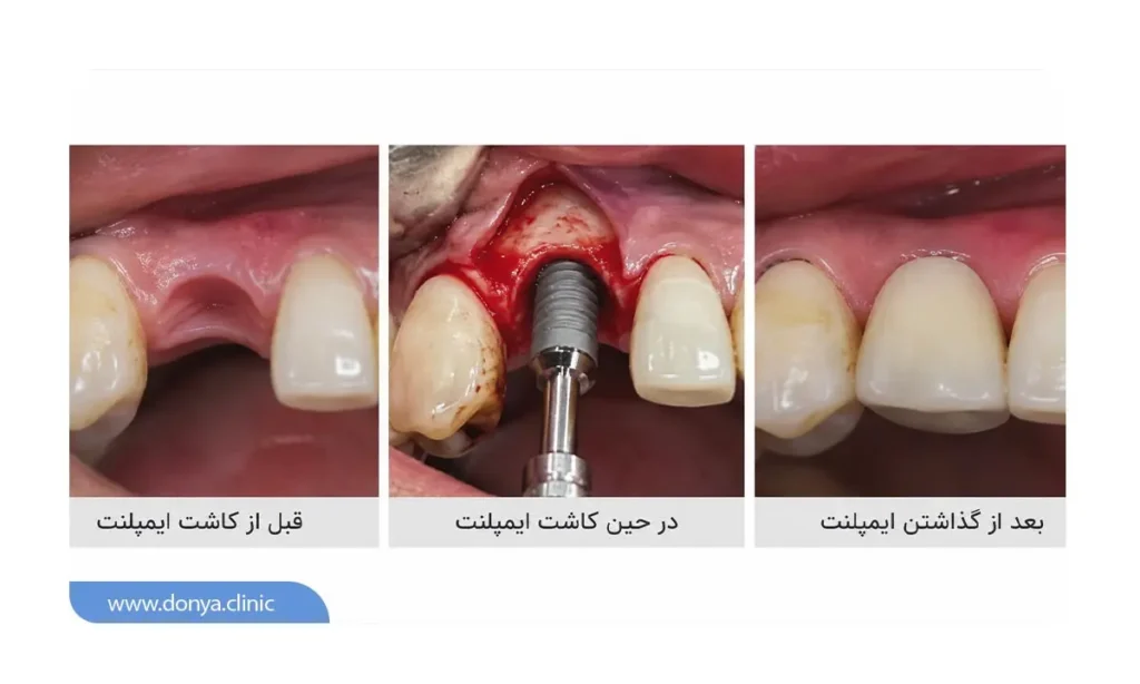 عکس قبل و بعد از ایمپلنت دندان