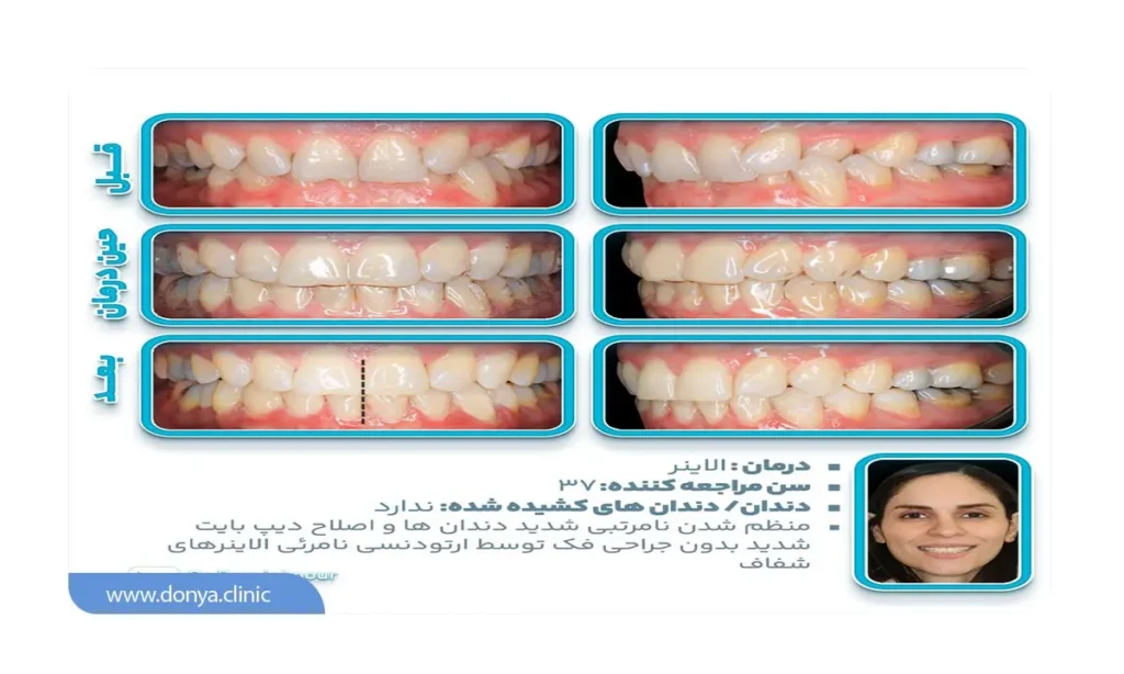 تصویر قبل و بعد از ارتودنسی