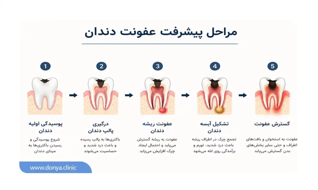اینفوگرافی نشان دهنده مراحل پیشرفت عفونت دندان