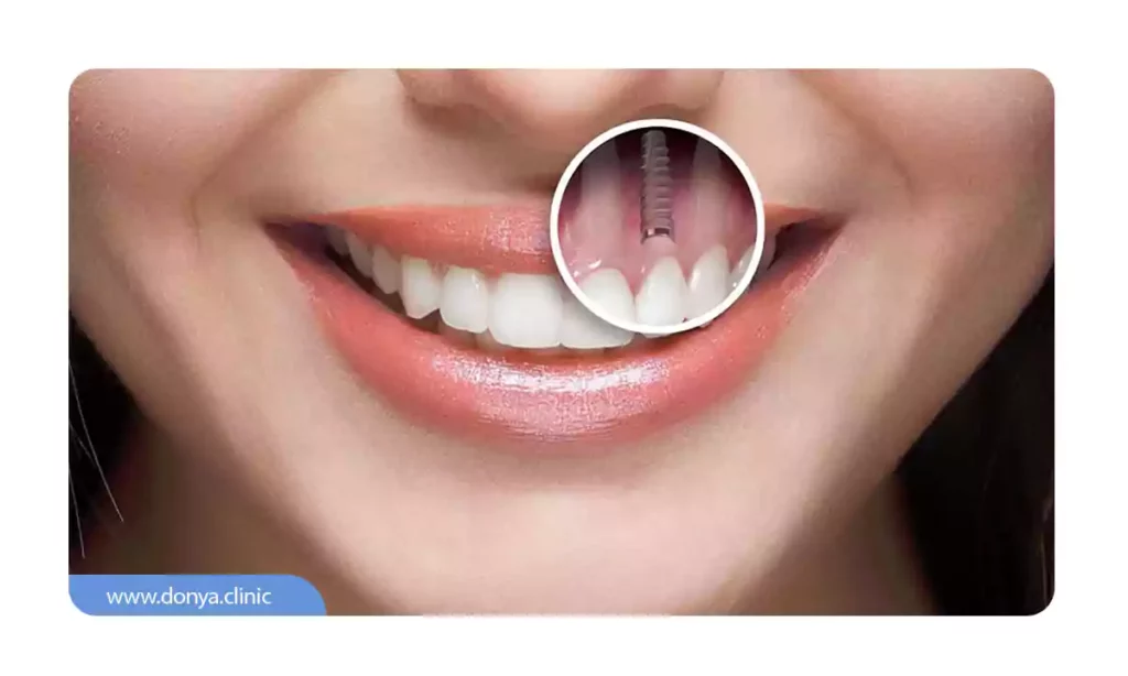 بازگردانی زیبایی طرح لبخند با کاشت ایمپلنت دندان