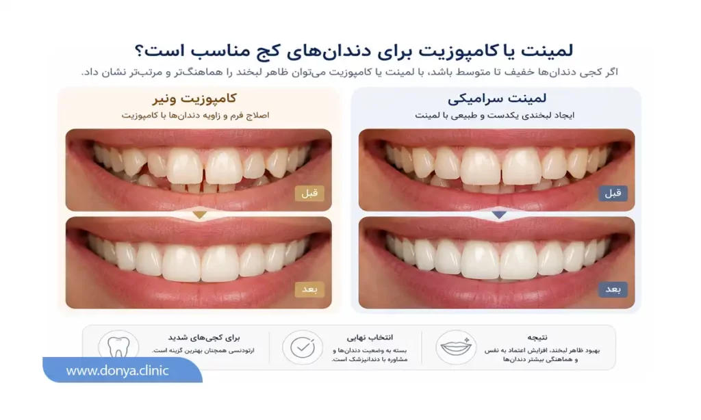 اینفوگرافی قبل و بعد تفاوت لمینت و کامپوزیت برای دندان های کج