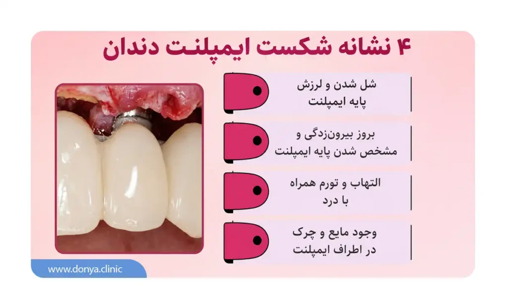 اینفوگرافی نشانه های شکست ایمپلنت