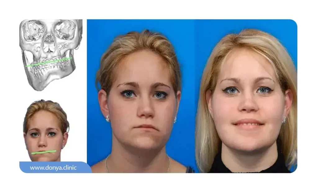 انحراف چانه چیست؟