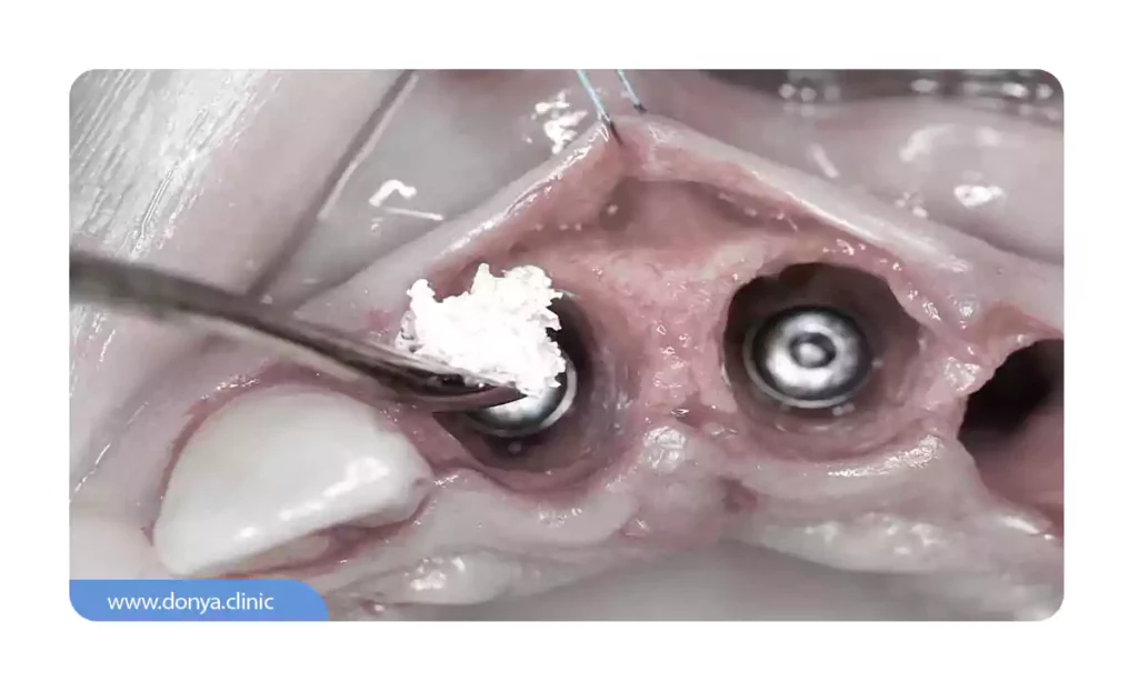 عکس پیوند استخوان دندان