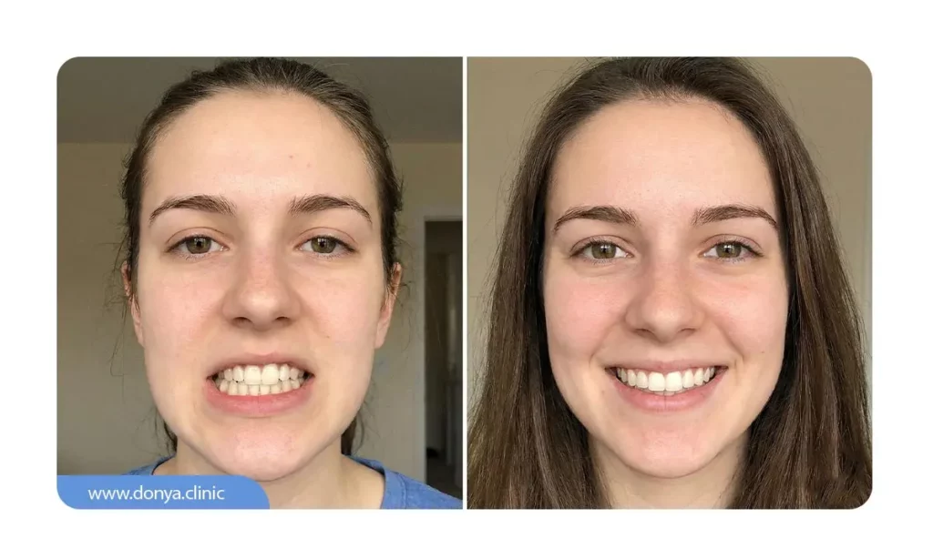 ارتباط انحراف چانه با ناهنجاری های فکی