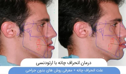 درمان انحراف چانه با ارتودنسی