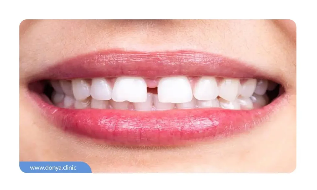 The-distance-between-the-teeth