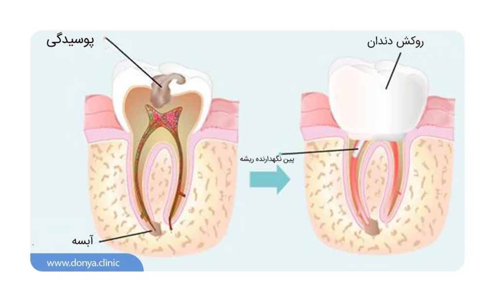 پر کردن دندان بعد از عصب کشی