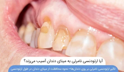 آیا ارتودنسی نامرئی به مینای دندان آسیب می زند
