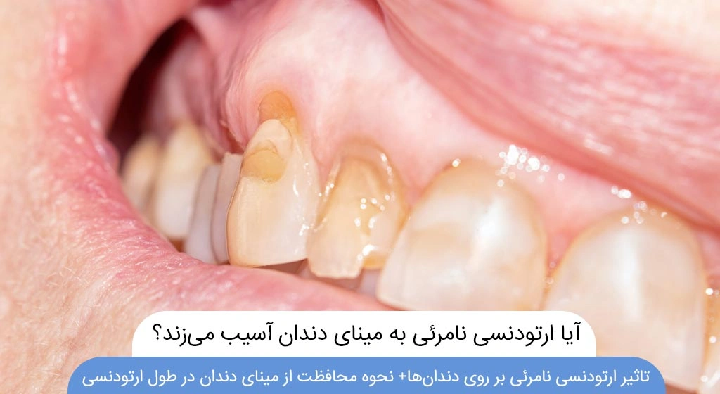 آیا ارتودنسی نامرئی به مینای دندان آسیب می زند
