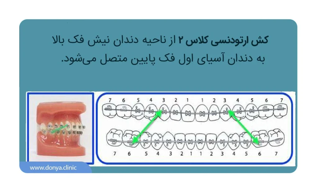 کش ارتودنسی کلاس 2