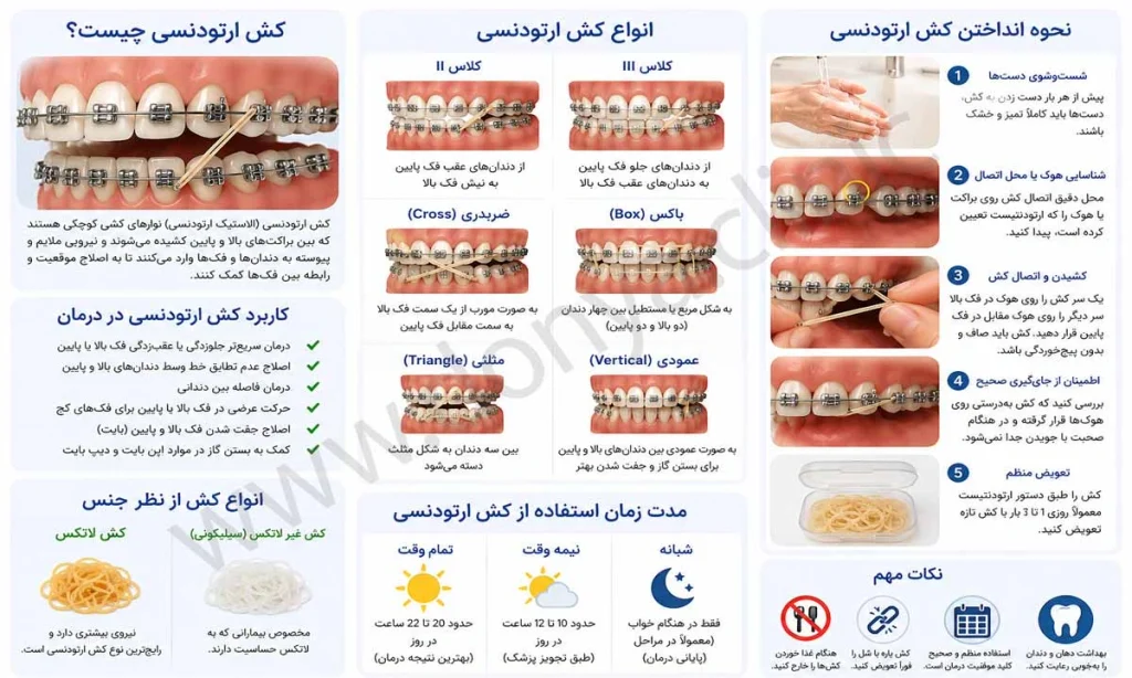 اینفوگرافی کش ارتودنسی چیست؟