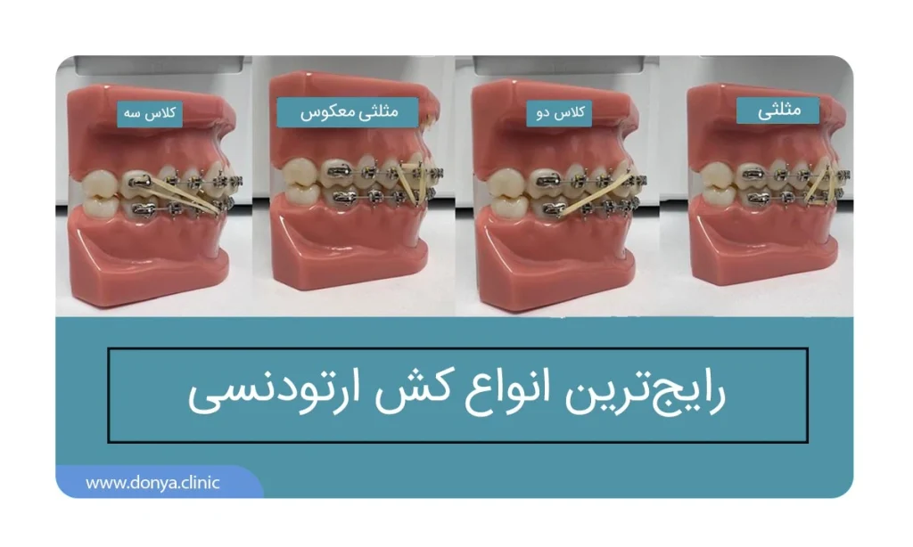 رایج ترین انواع کش ارتودنسی