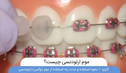موم ارتودنسی چیست